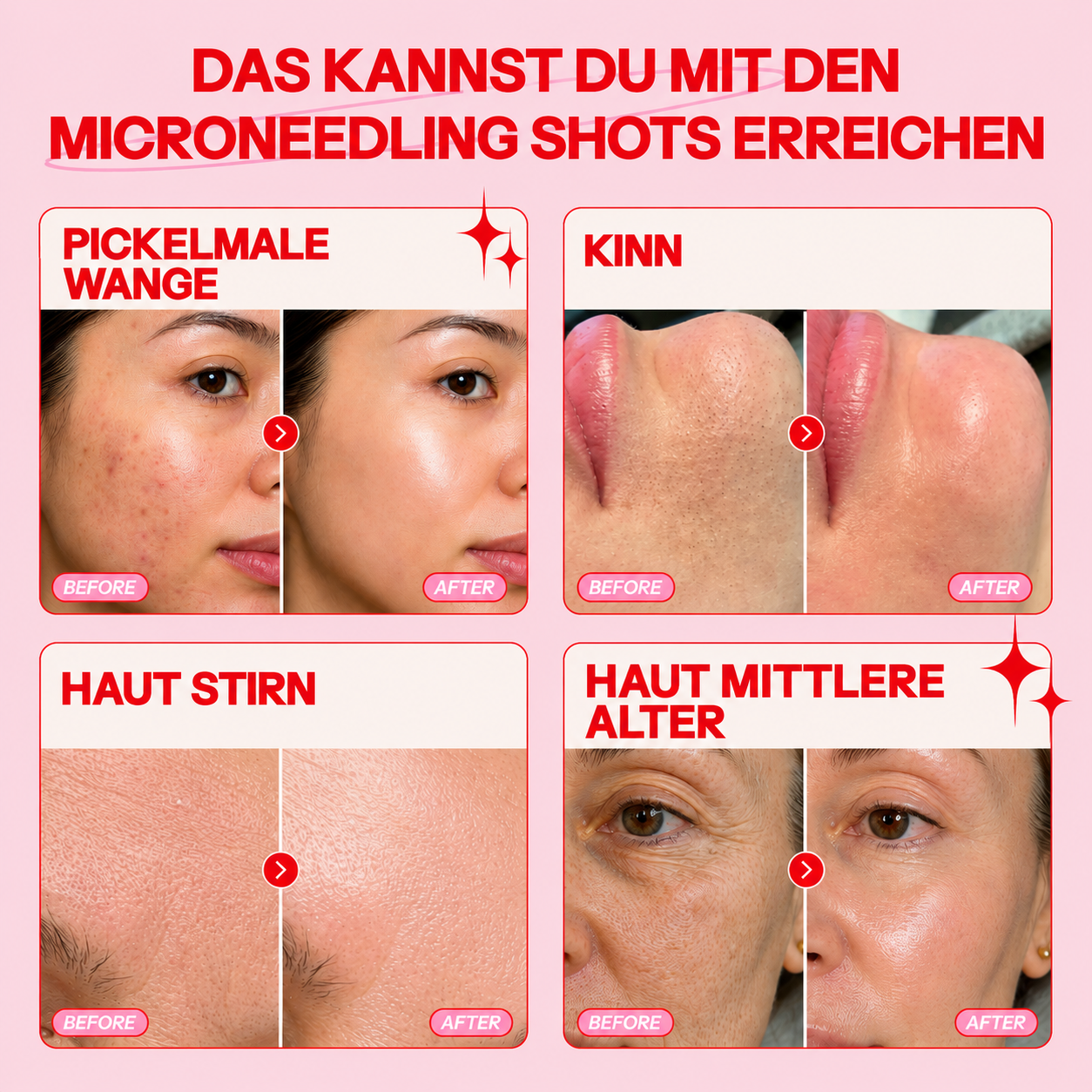 Bio-Microneedling | Needless Shot Set (+ gratis Milky Toner!)