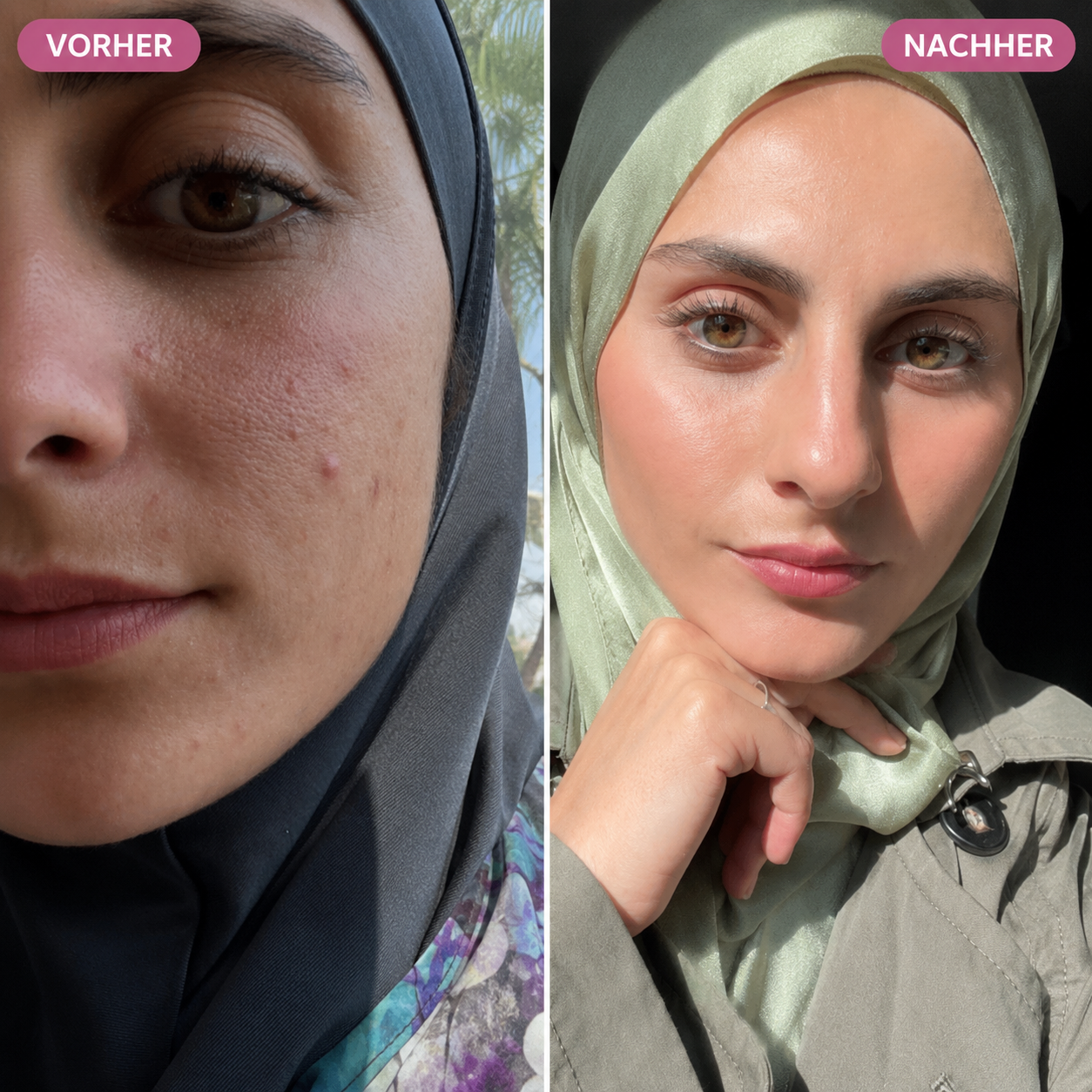 Bio-Microneedling | Needless Shot Set (+ gratis Milky Toner!)