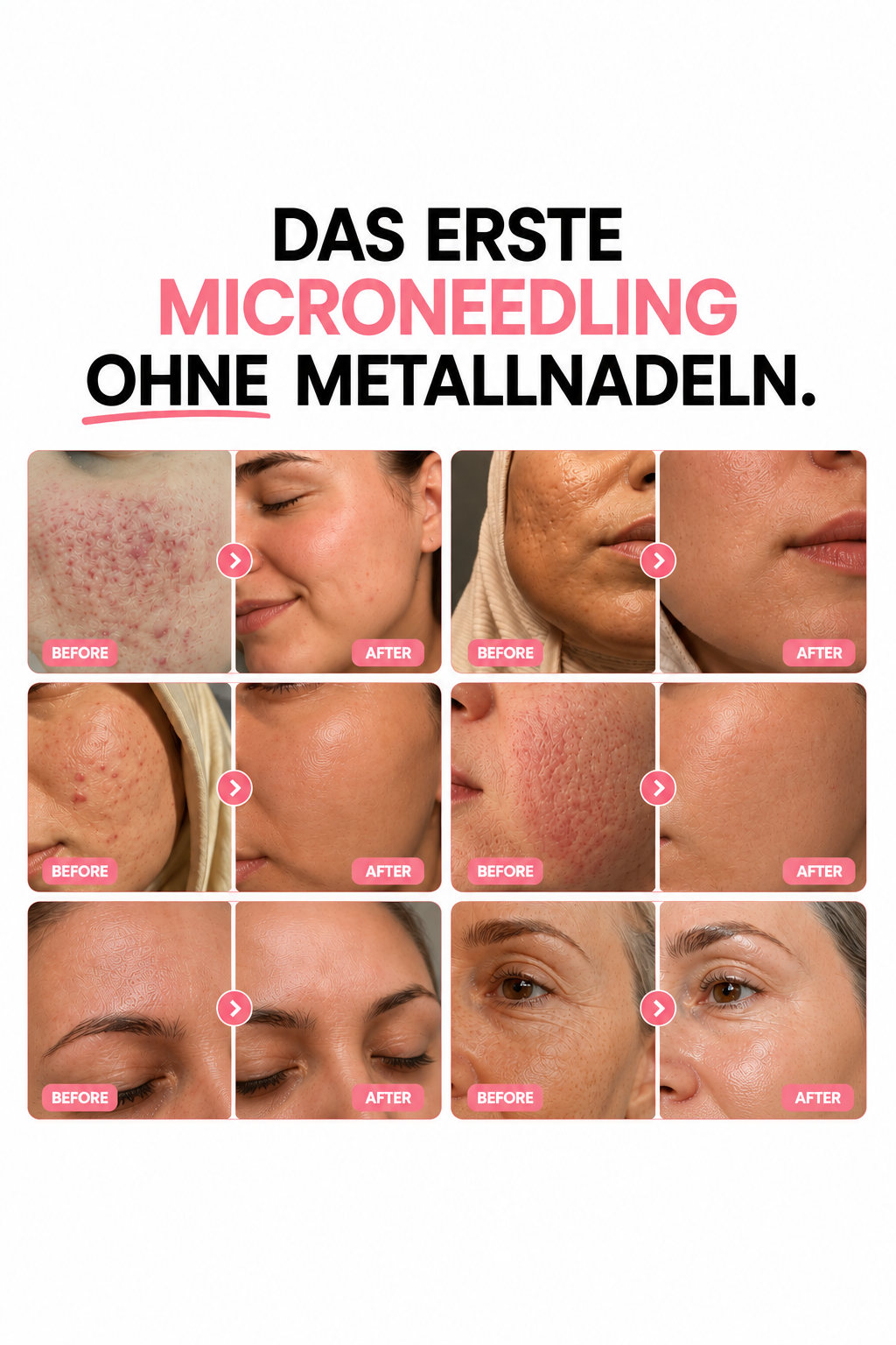 Bio-Microneedling | Needless Shot Set (+ gratis Milky Toner!)