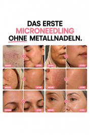 Bio-Microneedling | Needless Shot Set (+ gratis Milky Toner!)