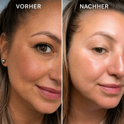 Bio-Microneedling | Needless Shot Set (+ gratis Milky Toner!)