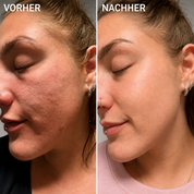 Bio-Microneedling | Needless Shot Set (+ gratis Milky Toner!)