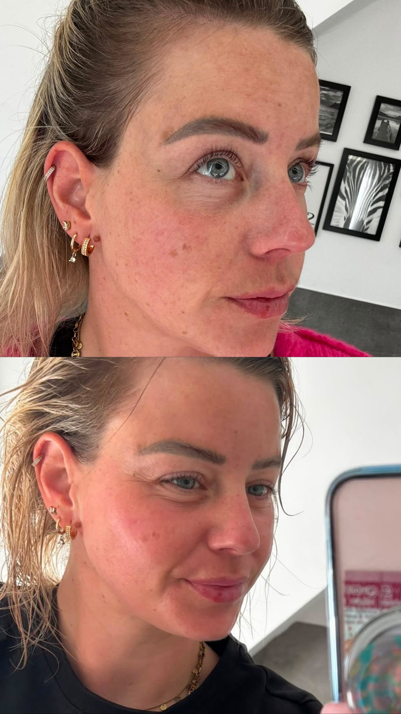 Bio-Microneedling | Needless Shot Set (+ gratis Milky Toner!)