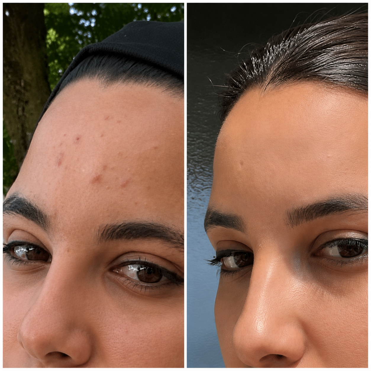 Bio-Microneedling | Needless Shot Set (+ gratis Milky Toner!)